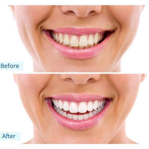 Brighten Your Teeth With BrightWhite!